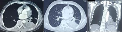 Case report: A case report and literature review about Pathological transformation of lung adenosquamous cell carcinoma